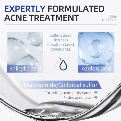 Acne Drying Lotion – Fights Inflamed & Pus-Filled Pimples Fast